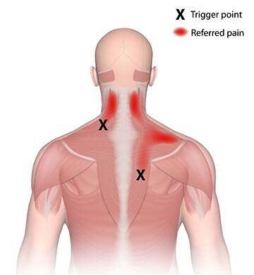 Anatomical figure drawing of the back of a torso showing inflammation in the neck and right shoulder