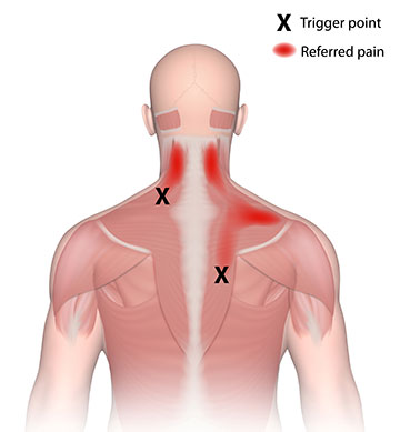 Anatomical figure drawing of the back of a torso showing inflammation in the neck and right shoulder