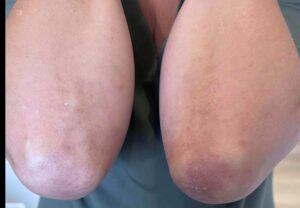 Psoriasis after Treatment