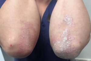 Before treatment elbows showing Psoriasis plaque, redness of skin, and scaling of skin.