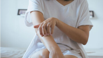 Woman with Psoriasis Sitting on a Table